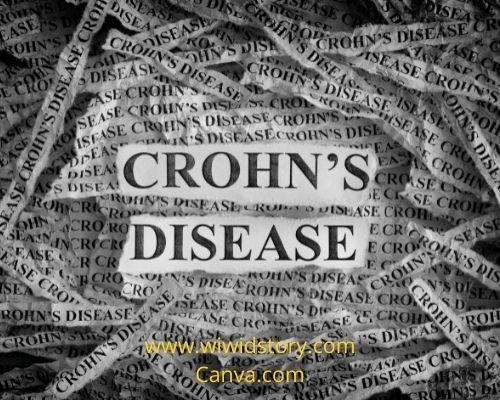Gejala Penyakit Crohn